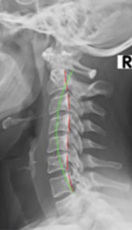 Lateral cervical X-ray with alignment lines marked