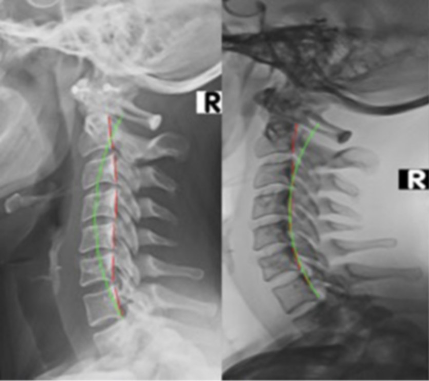 Two lateral cervical X-rays comparing alignment before and after corrective care