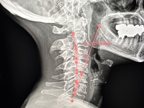 Cervical X-ray with alignment lines